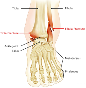 Ankle Fracture Treatment Broward & Palm Beach