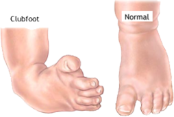 What Is Clubfoot? - Symptoms and Treatment