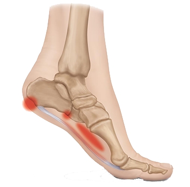 Heel Pain - Florida Foot & Ankle