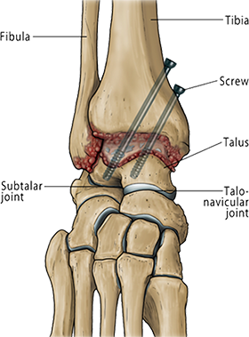 ankle arthrodesis in broward & palm beach