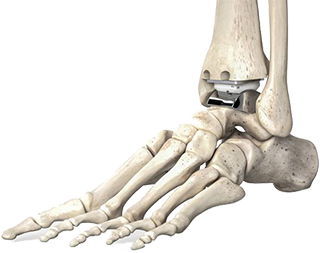 ankle joint replacement south florida