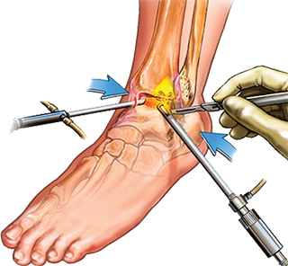 ankle arthroscopy in broward & Palm beach