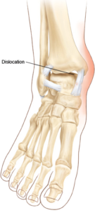 ankle dislocation treatment south florida