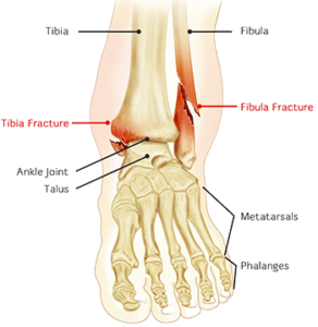 ankle fracture treatment south florida