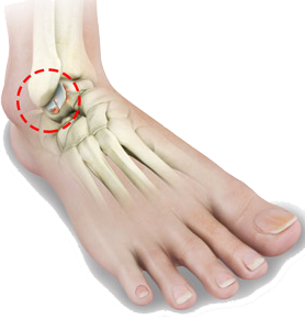 foot ankle arthritis treatment south florida