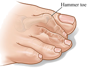 hammertoe treatment in south florida