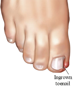 ingrown toenail treatment in south florida