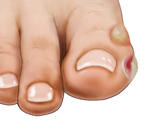 Blisters - Florida Foot & Ankle