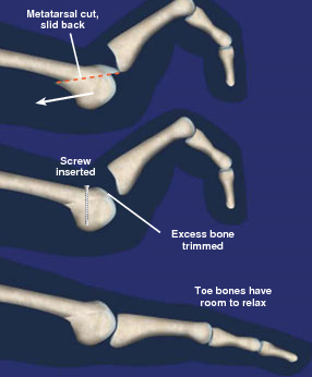 osteotomy procedure broward & palm beach