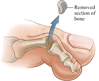 toe resection arthroplasty south florida