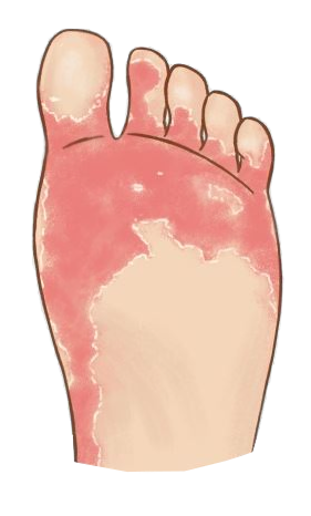 Types of Foot Fungus — Athlete's Foot Symptoms and Treatment – Love, Lori