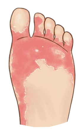 Athlete s Foot Symptoms Treatment Florida Foot Ankle