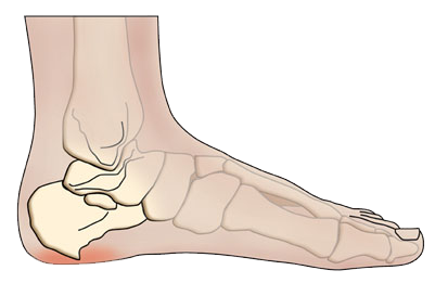 heel-spur