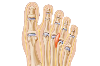 Mortons_Neuroma