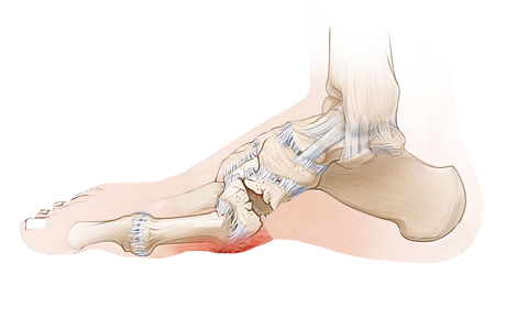 Charcot-Foot-Treatment