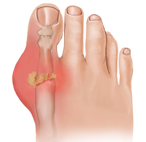 gout-treatment