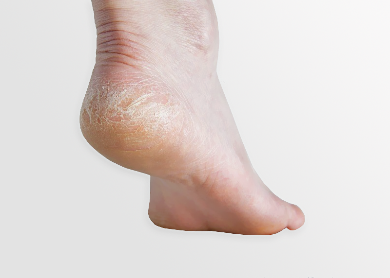 Follow These 6 Steps To Heal Cracked Heels Easily and Effectively