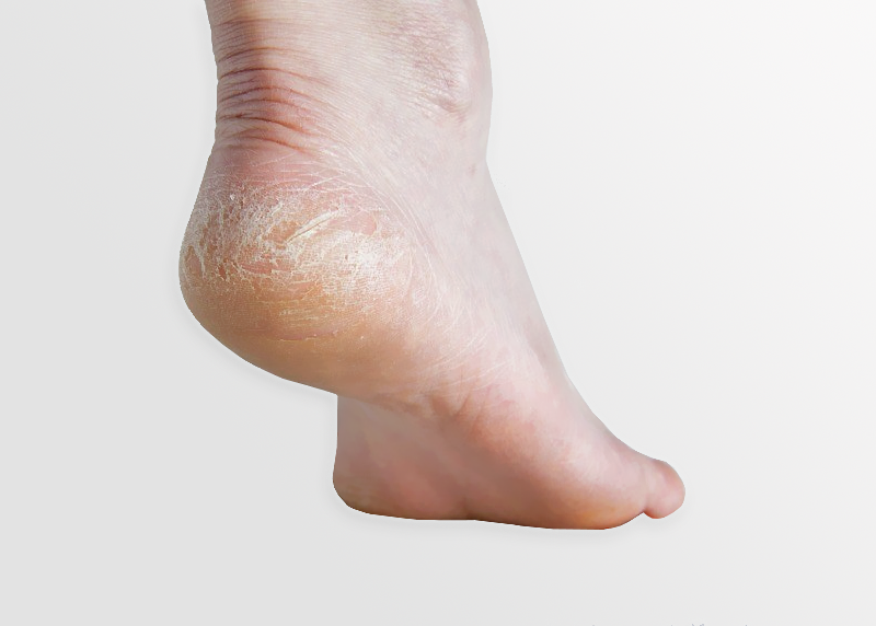 Heel fissures (cracked heels) | PhysioQinetics