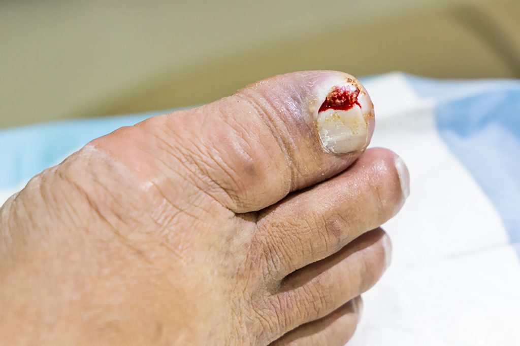 Diabetic Foot Problems & Symptoms