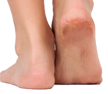 Corns and calluses develop on your skin to protect the skin from pressure and friction. Therefore, it creates hard layers of skin, called a corn or callus. Typically they develop on your feet, toes, hands, and fingers.